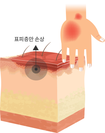 1도 화상(표재성 화상) 이미지