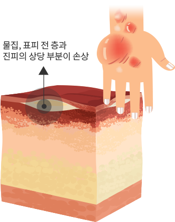 2도 화상(부분층 화상) 이미지