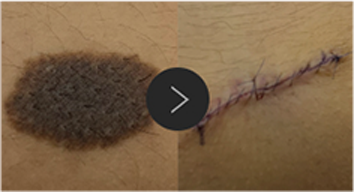 모반/양성종양/피지,표피낭종/지방종 수술,치료,제거 이미지