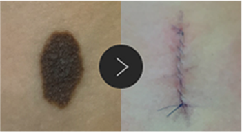 모반/양성종양/피지,표피낭종/지방종 수술,치료,제거 이미지