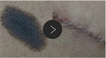 모반/양성종양/피지,표피낭종/지방종 수술,치료,제거 이미지