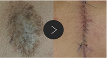 모반/양성종양/피지,표피낭종/지방종 수술,치료,제거 이미지