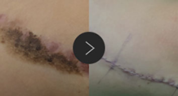 모반/양성종양/피지,표피낭종/지방종 수술,치료,제거 이미지