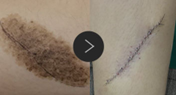 모반/양성종양/피지,표피낭종/지방종 수술,치료,제거 이미지