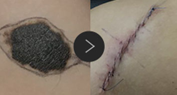 모반/양성종양/피지,표피낭종/지방종 수술,치료,제거 이미지