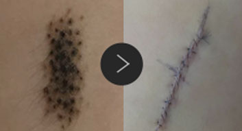 모반/양성종양/피지,표피낭종/지방종 수술,치료,제거 이미지