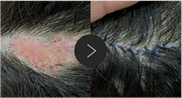 모반/양성종양/피지,표피낭종/지방종 수술,치료,제거 이미지