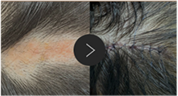 모반/양성종양/피지,표피낭종/지방종 수술,치료,제거 이미지