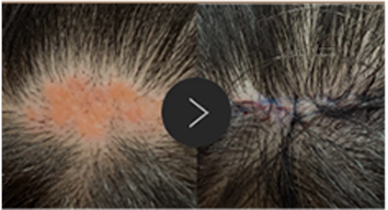 모반/양성종양/피지,표피낭종/지방종 수술,치료,제거 이미지