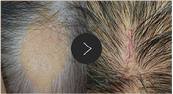 모반/양성종양/피지,표피낭종/지방종 수술,치료,제거 이미지