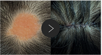 모반/양성종양/피지,표피낭종/지방종 수술,치료,제거 이미지