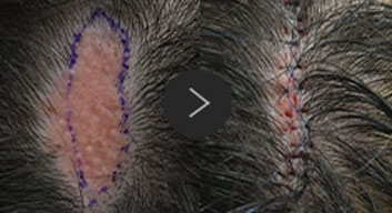 모반/양성종양/피지,표피낭종/지방종 수술,치료,제거 이미지