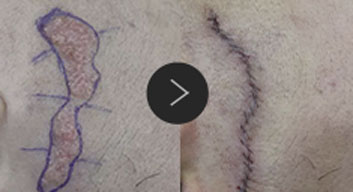 모반/양성종양/피지,표피낭종/지방종 수술,치료,제거 이미지