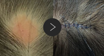 모반/양성종양/피지,표피낭종/지방종 수술,치료,제거 이미지