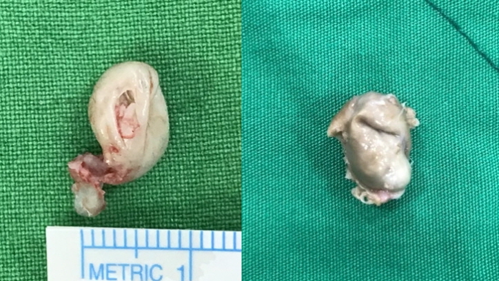 표피낭종(피지낭종) 염증이 생기면 어떻...