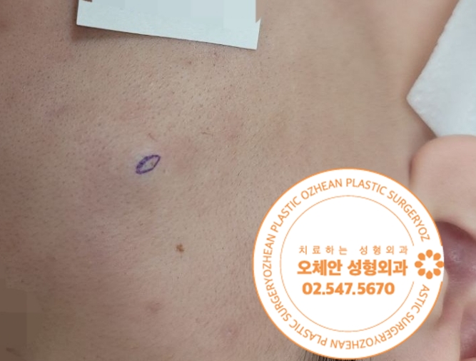 볼 표피낭종 방치하지마세요