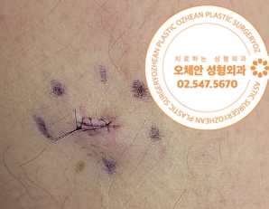 팔 멍울 여러개가 발생했나요?