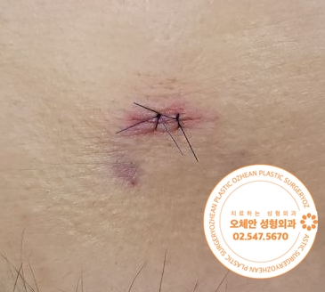 이마 종기 심각한것은 아닌지 걱정되시나요?