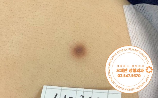 피부섬유종 제거 수술해야 하는 이유는 무엇일까요?