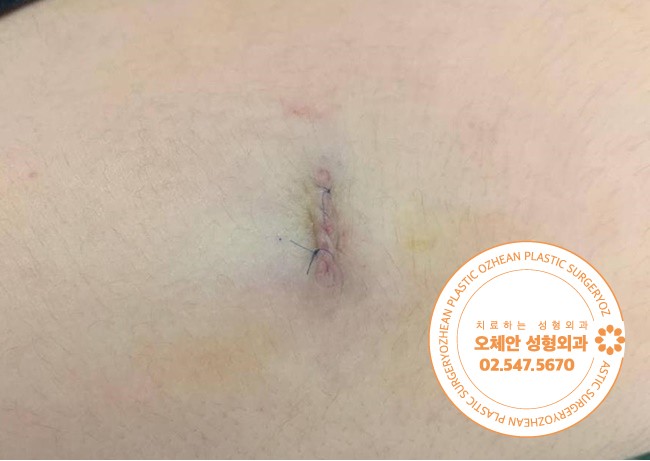 아이 얼굴, 팔에 잘 생기는 모기질종 수술