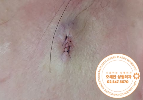 얼굴 모기질종 수술 후 관리도 중요해요