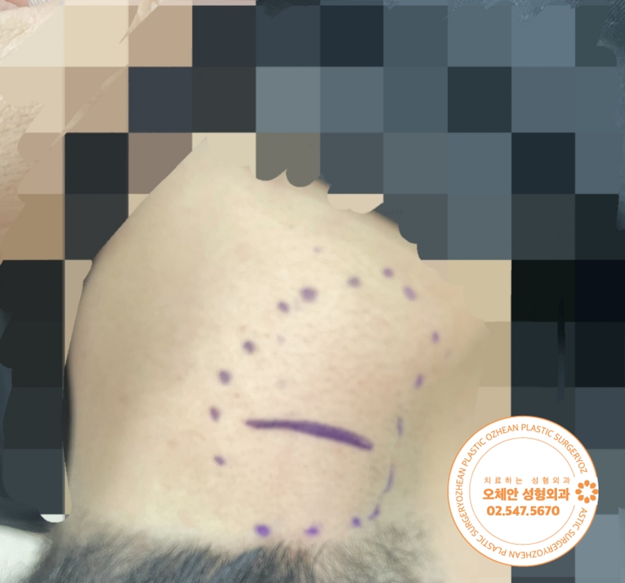 목 지방종 크기가 점점 커지고 계신가요?