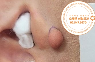 부이주 제거 아직도 망설이고 계세요?