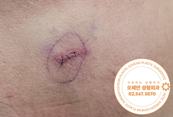이마 지방종 제거 커지기 전에 개선하세요!