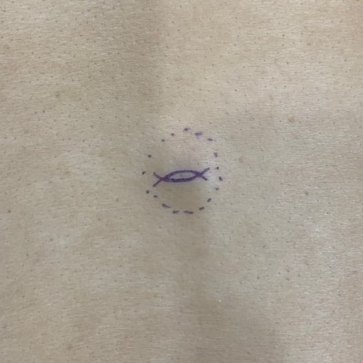 피부혹 제거하면 정상 피부색으로 돌아올까요?