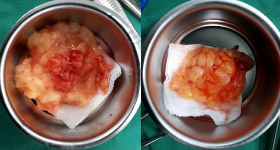 겨드랑이 지방종 제거 수술 크기와 모양 제각각이지만 흉터 줄이기 위해서는