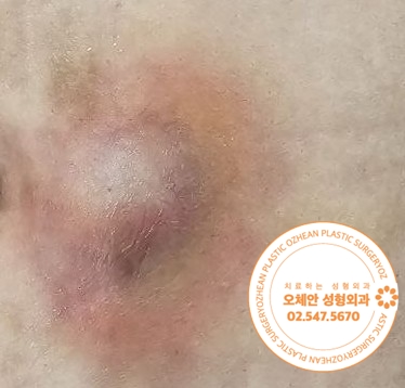 복부 혹 염증 치료 아직도 미루고 계세요?