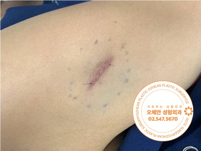 팔 지방종 피부혹 만져진다면 검사부터 제거까지!