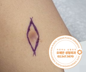 팔 섬유종 색이 점점 짙어지고 통증이 생기셨나요?