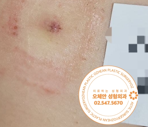 복부 염증 조직 더 악화되기 전에 제거 받으세요