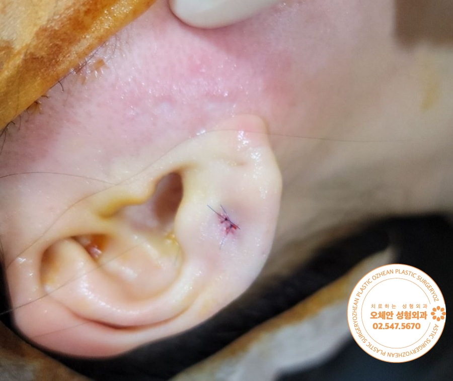 귓볼 표피낭종 통증 발생하기 전에 제거하세요