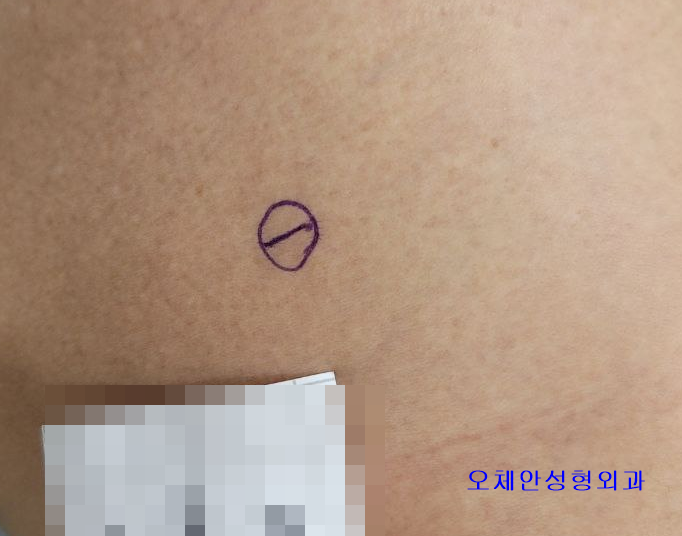 엉덩이 종기 제거 하지 않고 아직도 가...