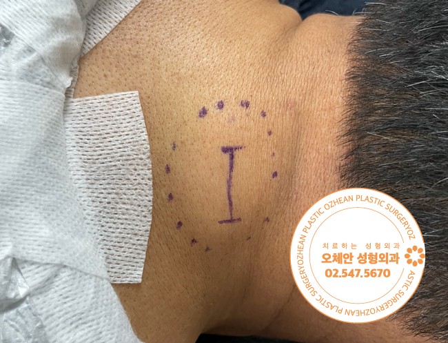 목뒤 통증없는 멍울이 생겼다면? 지방종...