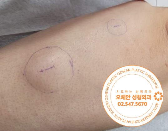 팔에 작은 혹이 발생하셨나요?