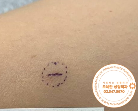 다리에 혹 계속 신경쓰이지 않으신가요?