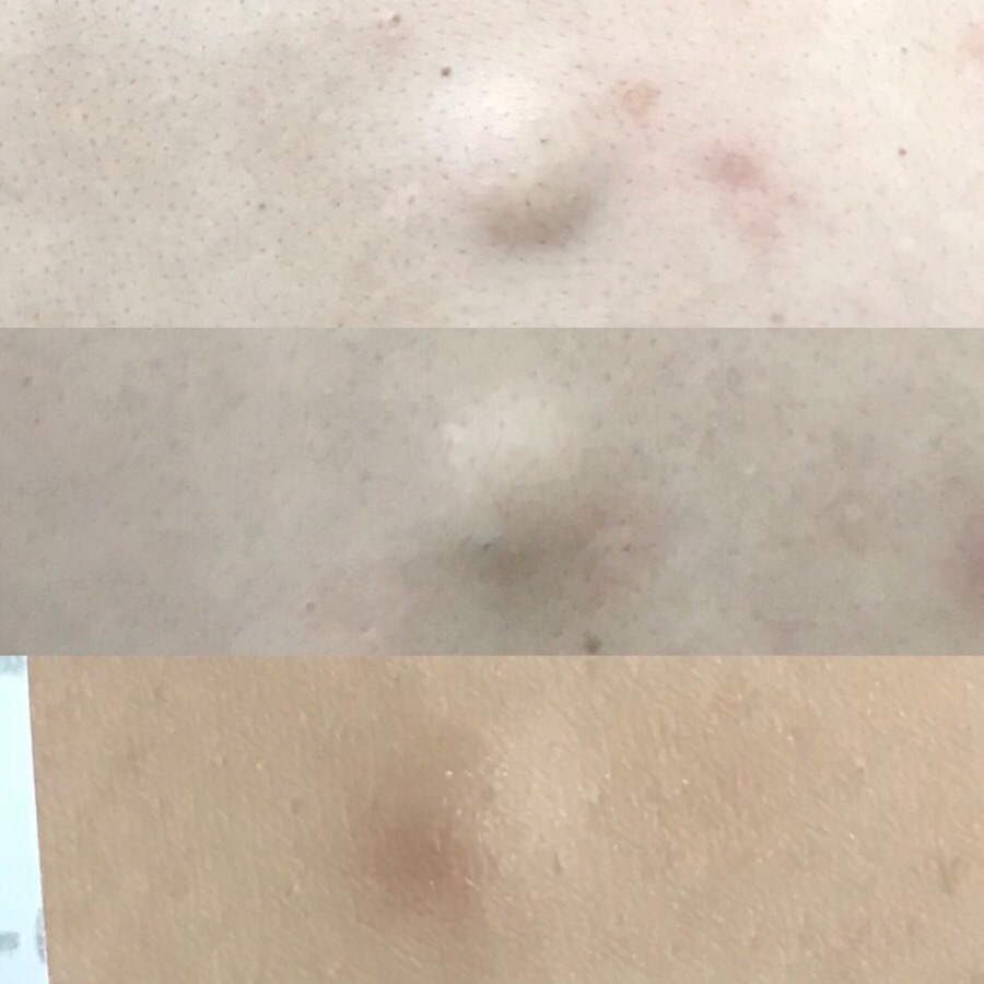 내 피부의 시한폭탄, 피지낭종! 치료시기를 놓치지 마세요!