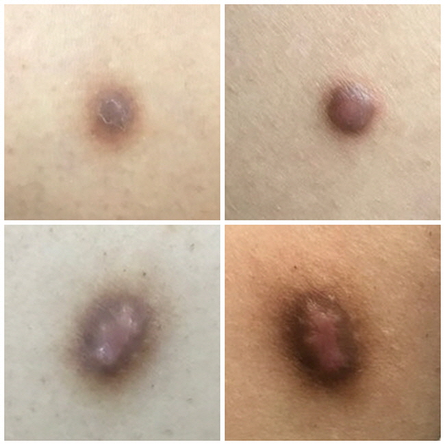 피부에 생긴 혹! 피부섬유종이란?! 제...