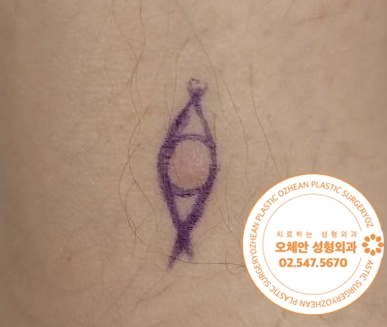 팔에 종기 피부섬유종이 의심된다면 빠르게 제거하세요 
