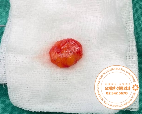 얼굴 혹 스트레스 받지 마시고 제거하세요!