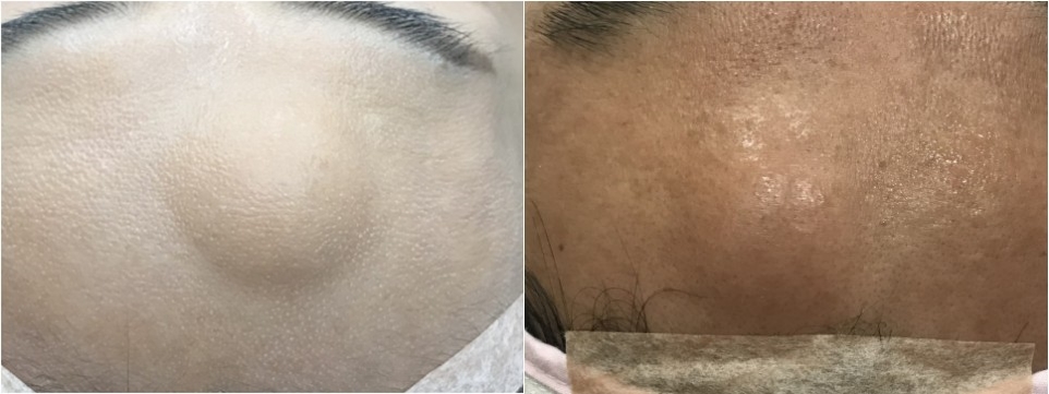 이마 지방종 제거는 성형외과에서!