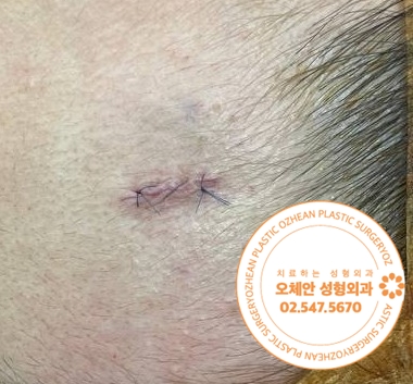 이마 멍울 작을 때 제거해야 흉터 줄일 수 있습니다.