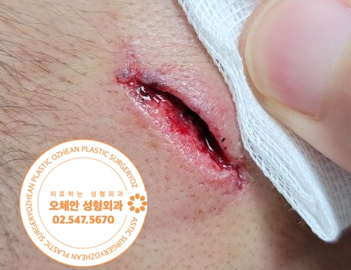안면부 열상 치료 미뤄질수록 흉터가 보...