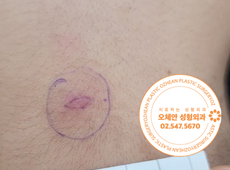 목 뒤 종양 염증 생기기 전에 제거 하세요!