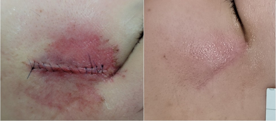 얼굴 찢어진 상처 열상 상처봉합 치료할...
