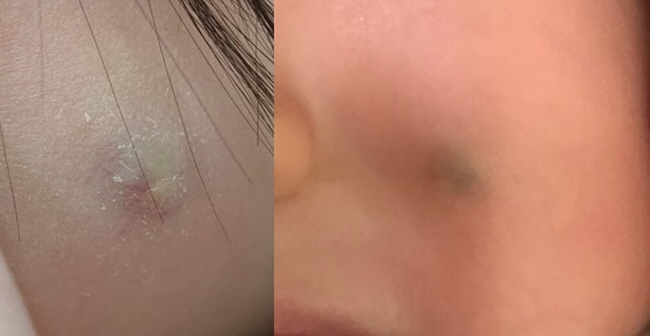 우리 아이 털바탕질종,모기질종,털기질종 크기가 작을 때 제거하세요!