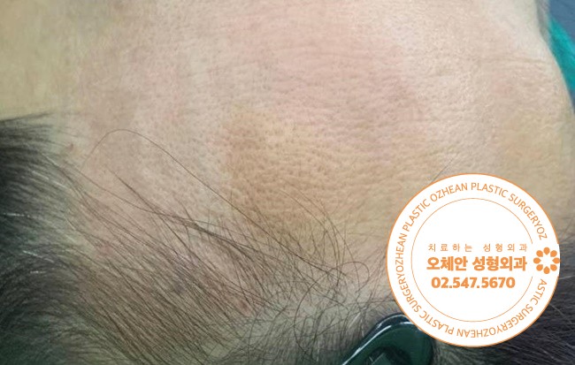피부에 생긴 말랑한 혹 정체가 무엇일까요?